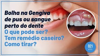 Bolha na Gengiva de pus ou sangue perto do dente O que pode ser Tem remédio caseiro Como tirar [upl. by Osana356]