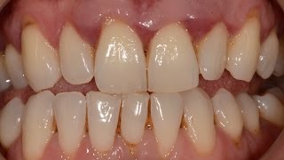 Treatment of Advanced Periodontal Gum Disease with Non surgical and Surgical Periodontal Therapy [upl. by Mueller]