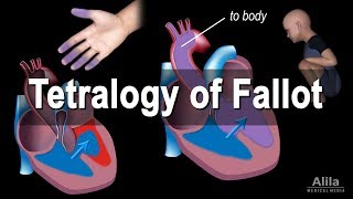 Congenital Heart Disease Tetralogy of Fallot Animation [upl. by Acinej]