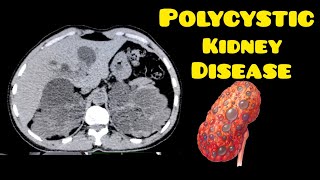 Polycystic kidney liver disease  CT Scan  Radiology [upl. by Anitsirhcairam]