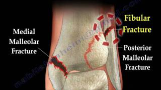 Ankle fracture  Fractures and its repair Everything You Need To Know  Dr Nabil Ebraheim [upl. by Polard423]