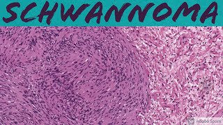 Schwannoma 5Minute Pathology Pearls [upl. by Bushore]