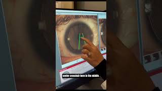 Corneal Topography Demonstration [upl. by Britton]