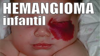 HEMANGIOMA INFANTIL 👶🏻 ¿Por Qué Salen y cómo Eliminarlos 🔴 DR IVAN GUTIERREZ ROMERO 🩺 FLEBOCENTER [upl. by Siro29]