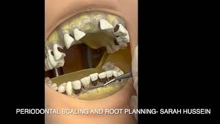 periodontal scaling and root planning by sarah hussein [upl. by Dunn]