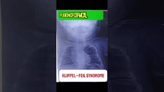 KlippelFeil Syndrome  Congenital Musculoskeletal Disorder medicalstudent mbbs doctor [upl. by Oisinoid299]