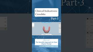 Clinical Indications Crossbite Part 3 [upl. by Sanez]