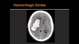 Atherosclerosis Hemorrhagic Stroke Ischemic Stroke amp Transient Ischemic Attack TIA [upl. by Shaddock]