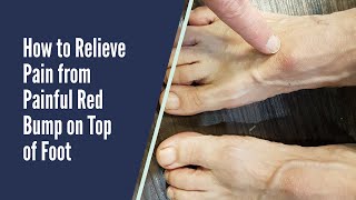 PAIN RELIEF FOR RED BUMP ON TOP OF FOOT [upl. by Atteuqal]