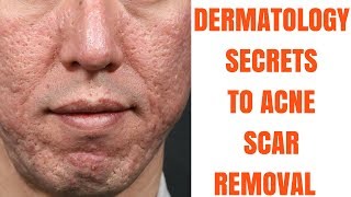 Acne scar treatments ULTIMATE GUIDE [upl. by Toole273]