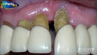 Curso Plástica Periodontal  clasificación de recesiones gingivales [upl. by Iz]