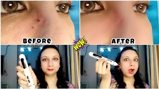 How to remove mole using mole remover pen  best product to make your skin clear mole skin viral [upl. by Harbird20]