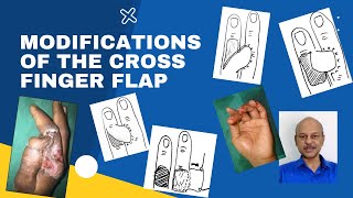 MODIFICATIONS OF THE CROSS FINGER FLAP IN DESIGN IN TECHNIQUE AND IN THE DONOR FINGER [upl. by Eirb]