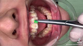 ¡Combinación de fuerzas entre alineadores dentales y elásticos [upl. by Lagas]