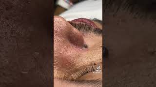 OMG😰😰😰You can Easily Satisfy With This asmr viralvideo satisfying video blackheads 6666 [upl. by Ahseei446]