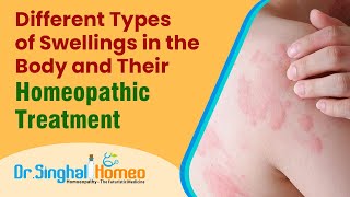 Swelling and Homeopathy Treatment [upl. by Eniamahs]