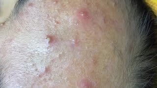 inflamed forehead and cheek acne  dermacool 0217 [upl. by Yentruoc]