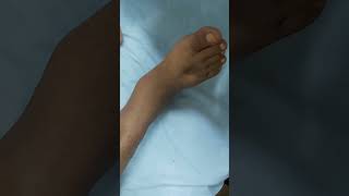 Pitting edema  DCLD patient clinicalexamination hospital doctor [upl. by Idnahk]