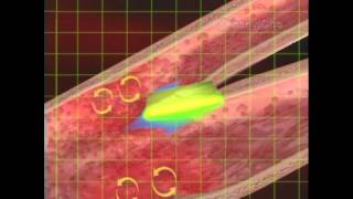 Whole Blood Viscosity Links to Cardiovascular Disease [upl. by Weldon]