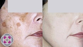 How to Get Rid of Dark Spots and Age Spots on Face [upl. by Rettig238]