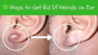 10 Ways to Get Rid Of Keloids on Ear  keloid Scar Removal [upl. by Ravahs]