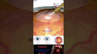 Cataract  Lens Implant  Medical Arts Shorts  3d animation surgery [upl. by Hoagland]