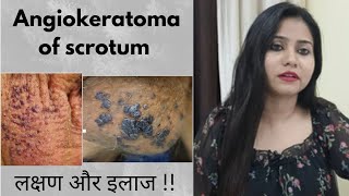 Angiokeratoma of fordyceScrotum homeopathic treatment  Angiokeratoma symptomscauses amp medicine [upl. by Holle]