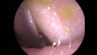 271  Ear Wax Removal using Jobson Horne Zoellner Sucker and Sodium Bicarbonate [upl. by Kamillah]