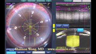 Lensx laser cataract surgery  brunescent cataract 101512 [upl. by Namien]