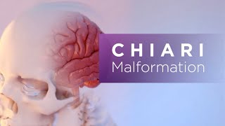 Chiari Malformation [upl. by Torres179]