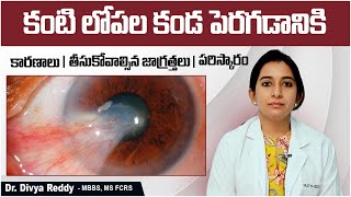 కంటిలో కండకు  Pterygium Causes and Treatment  Eye Care Tips In Telugu  Best Vision Eye Hospital [upl. by Lachish]