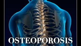 Osteoporosis in Thalassemia Early Symptoms Causes Treatments Prevention and More [upl. by Quintina]