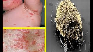 Scabies What Is It  Signs Symptoms Causes Spread and Treatment [upl. by Ignatzia]