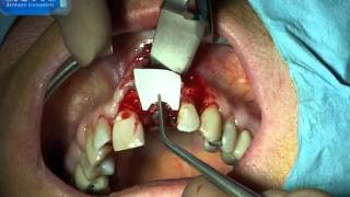 actis dentaire formation  avulsion implantation immédiate ROG immediate implant placement GBR [upl. by Senecal188]