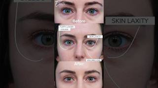 How Blepharoplasty glow your skin whats impact of blepharoplasty in your facecosmeticsurgery [upl. by Combe]