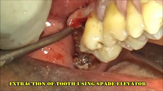 Severely infected upper right 3rd molar extraction [upl. by Analrahc999]