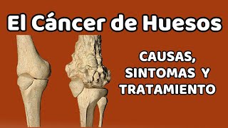 CÁNCER DE HUESOS Causas signos y síntomas diagnóstico y tratamiento [upl. by Antipas101]