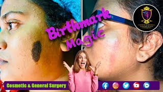 Plastic Surgery Sri Lanka Birthmark Dr Ananda Jayawardhana උපන්ලප [upl. by Yraht]