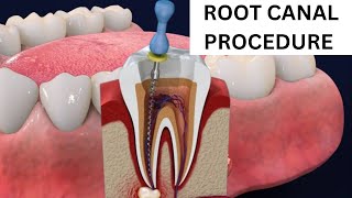 Root Canal Procedure Step by Step [upl. by Eirena34]