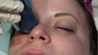 Does Thermage Skin Tightening Laser Treatment hurt [upl. by Opportuna]