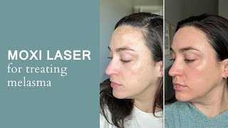 MOXI LASER FOR MELASMA [upl. by Dnalyaw]