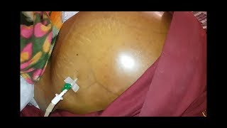 Ascites Fluid Tapping Procedure  Percentesis [upl. by Otreblide]