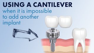 Using a cantilever when it is impossible to add another dental implant [upl. by Ahsit377]