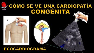 Persistencia del Conducto Arterioso  Ecocardiograma [upl. by Eloci250]