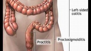 Treatment of Proctitis [upl. by Midge]