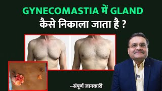 Gynecomastia में Gland कैसे निकाला जाता है   Trans Nipple Gland Reduction OR Perioral Techniques [upl. by Schwarz549]