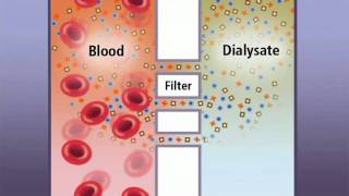 Hemodialysis and how it works  IKAN ch6  old vrs [upl. by Dierdre]