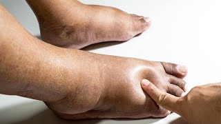 EDEMA DIFFERENTIAL DIAGNOSIS [upl. by Anippesuig]