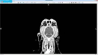 Case Study Treating a Brain Tumor with Stereotactic Radiosurgery SRS  PetCure Oncology [upl. by Cirdet478]