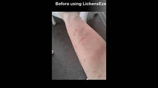 LichensEze Lichen Planus Relief cream Cure the rash guaranteed [upl. by Eadrahs]